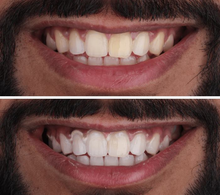 Teeth whitening before and after, Oakville dental patient