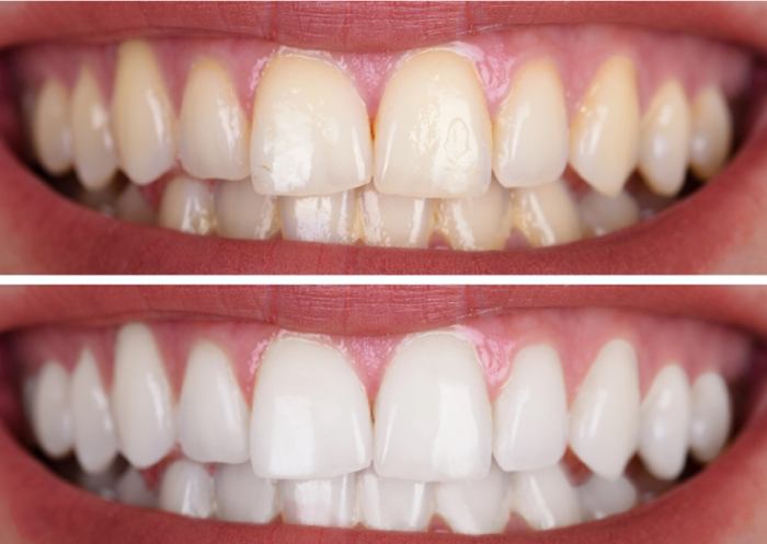 Teeth whitening before and after, Smile Point Dental Oakville