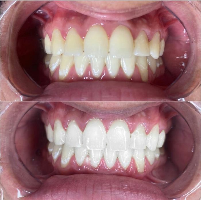 Teeth whitening result at our Oakville dental office
