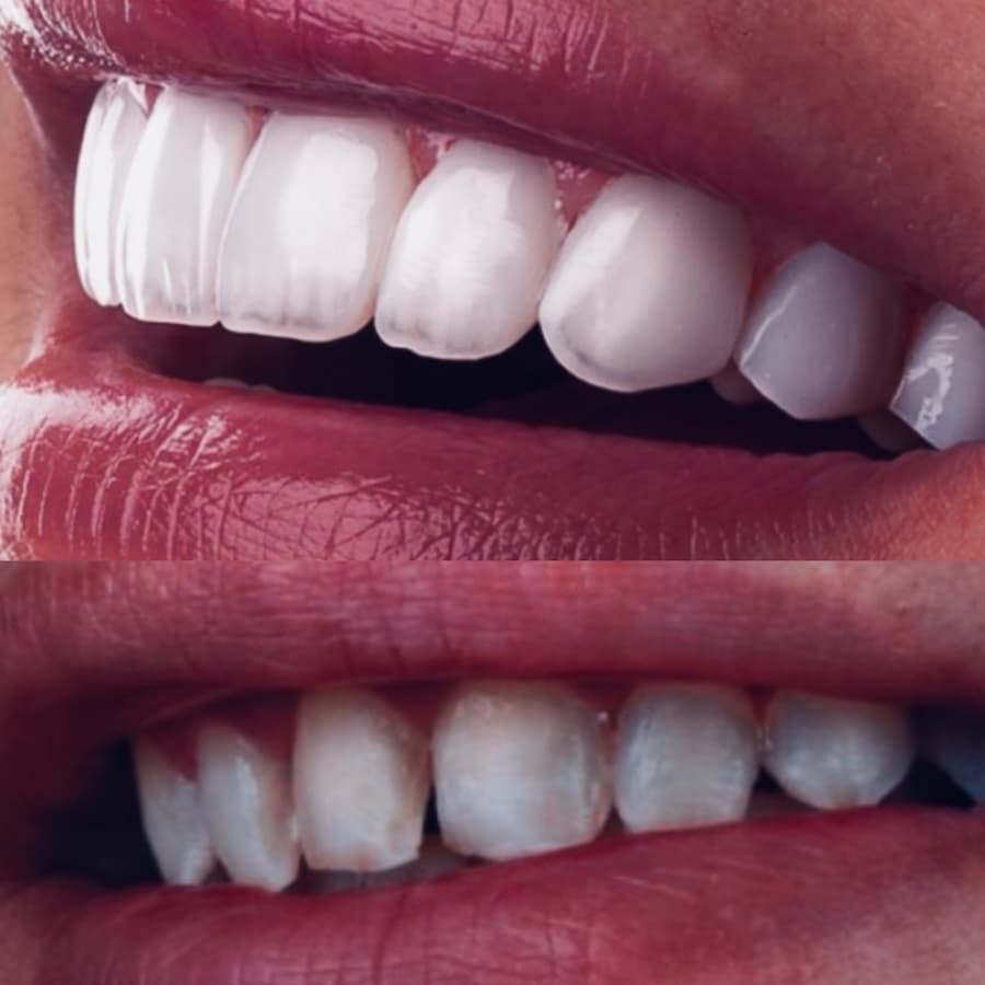 Dental veneers before and after at Smile Point Dental Oakville