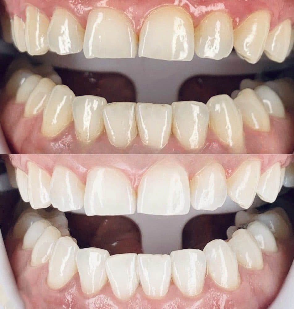 Teeth whitening result, Smile Point Dental Oakville