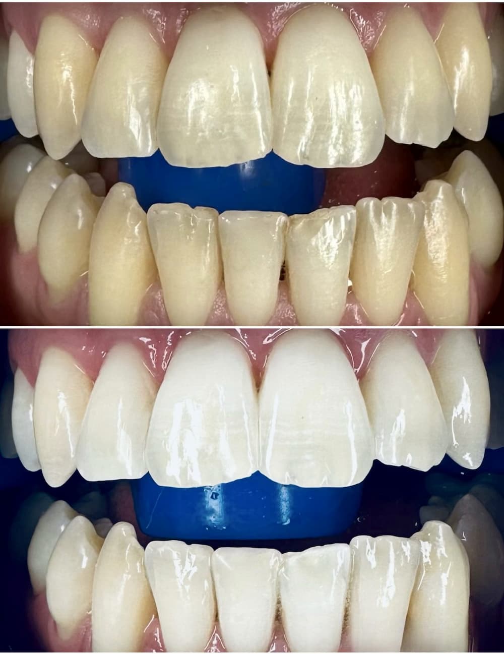 Teeth whitening before and after at Smile Point Dental Oakville