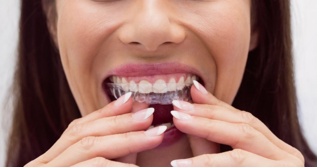 Close-up of a woman’s mouth putting in a retainer for teeth straightening