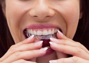 Close-up of a woman’s mouth putting in a retainer for teeth straightening
