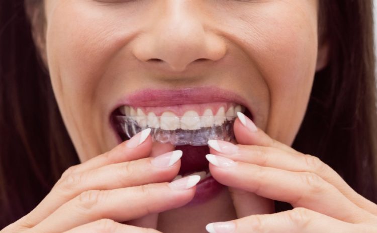  Retainer for Teeth Straightening: How it Can Help