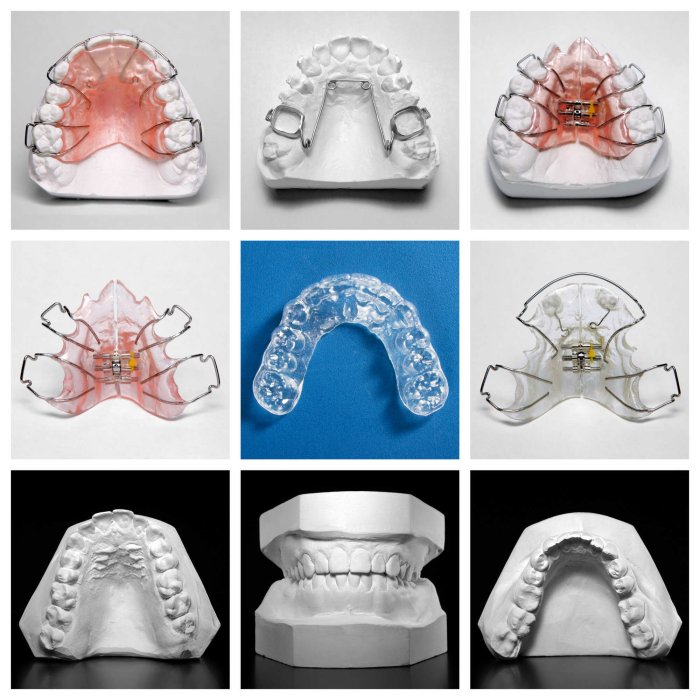 Images of different types of retainers for teeth straightening
