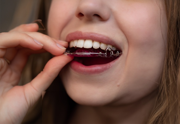 Close-up of a young woman’s face putting a retainer in her mouth