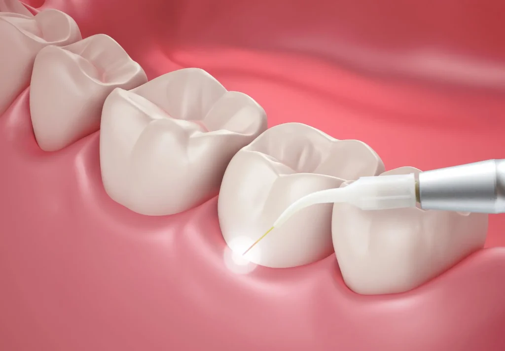 What Is Gum Contouring?