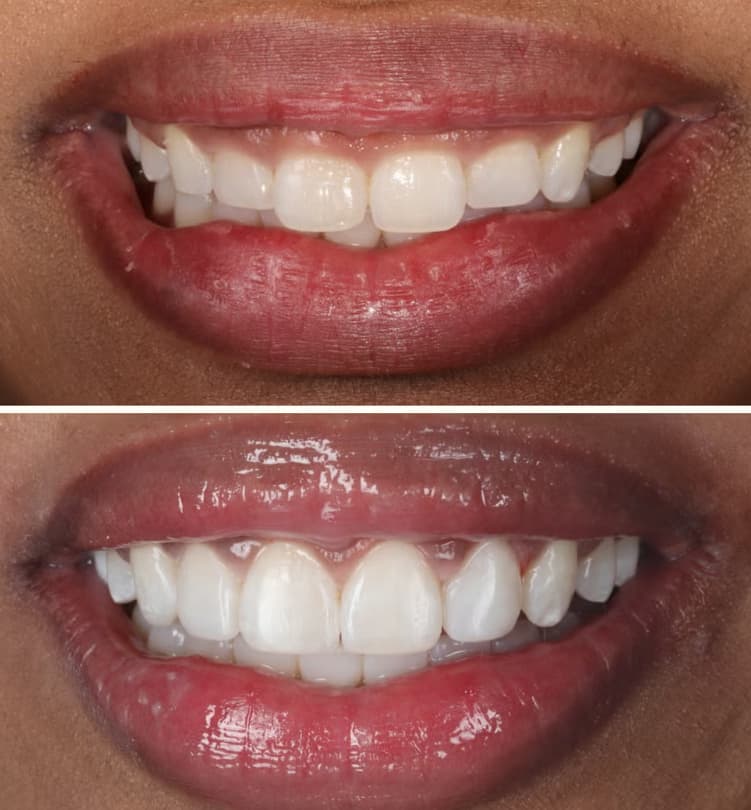 Gum Contouring