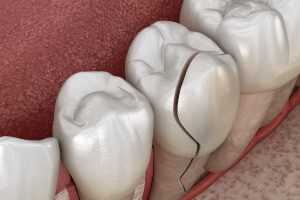 Emergency Cracked Tooth Repair in Oakville​