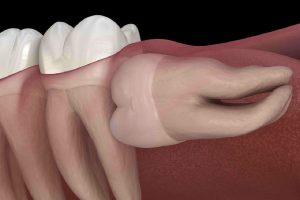 Gentle Wisdom Tooth Removal in Oakville